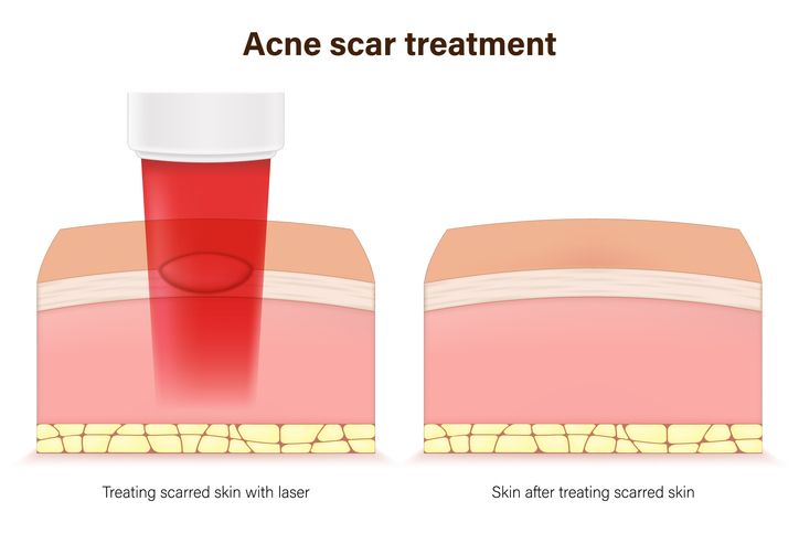 【激光去印】可改善4個肌膚問題&注意事項解析 有副作用嗎？