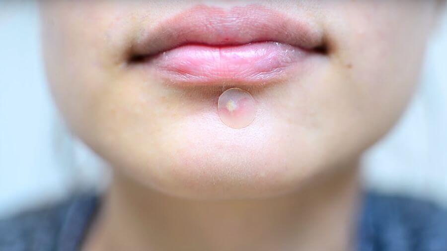 暗瘡貼原理是甚麼？