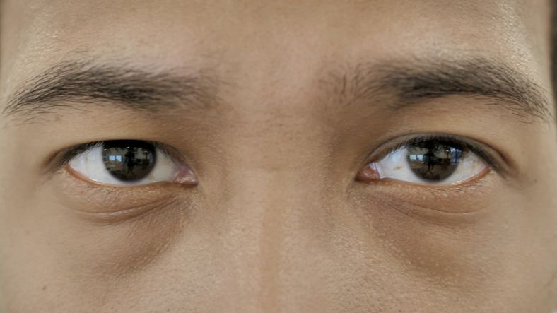 割眼袋科普：4大專業手術方式與需注意事項 如何避開副作用？