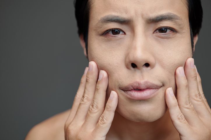 虎紋分3種，側睡令法令紋加深！消除虎紋4大方法！虎紋貼有效嗎？微針面膜的原理！