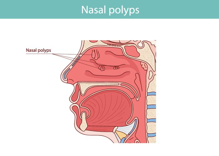 鼻息肉會自己好嗎？盤點6大常見症狀+藥物與手術治療方法！
