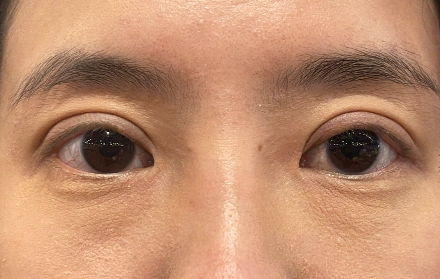 去眼袋前必知:常見的眼袋類型