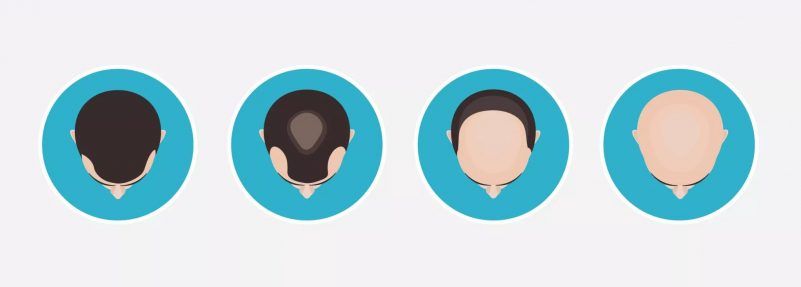 雄性禿的7個階段