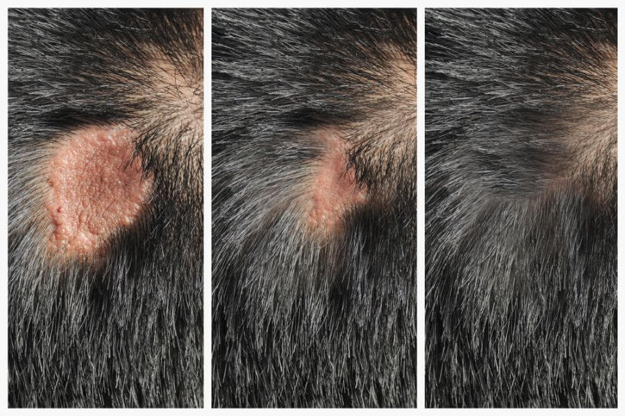 頭瘡可導致甚麼後果？