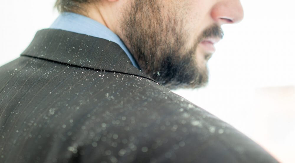 男士髮量少的4個指標！快看看自己有沒有中招！