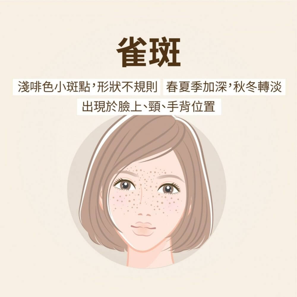 想美白去斑?色斑分為甚麼種類?