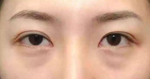 眼袋大是真是假？眼袋vs臥蠶vs淚溝的分別