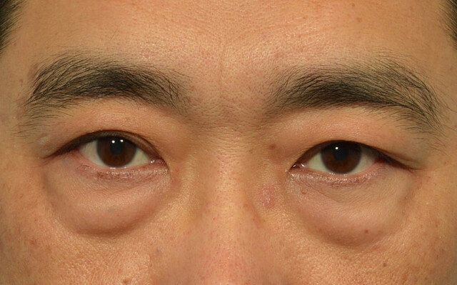 淚溝、眼袋、黑眼圈、臥蠶傻傻分不清？