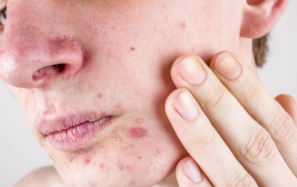 中醫:荷爾蒙失調源自心火旺、肝火旺及肝胃濕熱