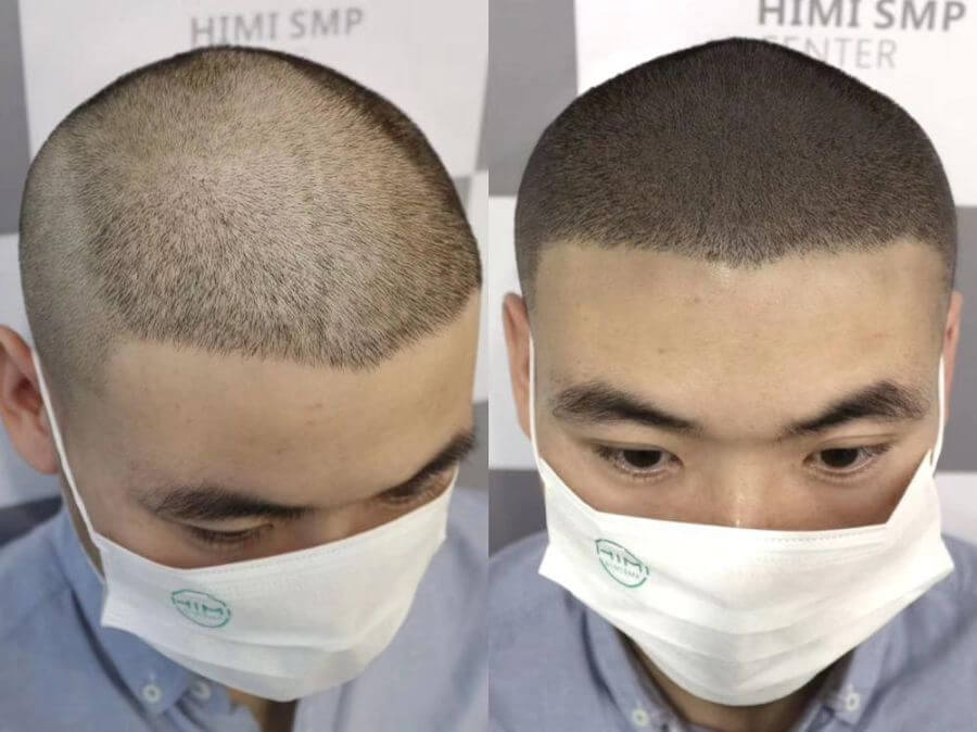 改善髮線高有甚麼方法？半永久紋髮際線是否一勞永逸？