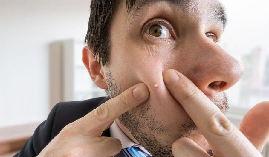 暗瘡貼可以用在甚麼暗瘡種類之上？