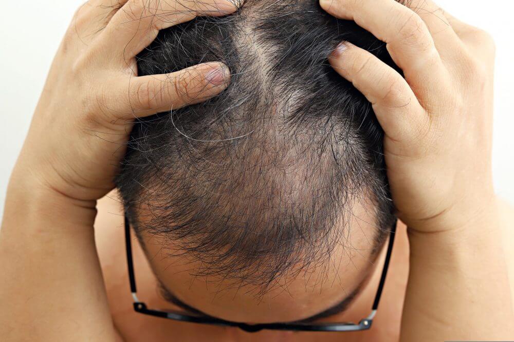 植髮改善髮際線高是最好方法？當中風險你要知道！