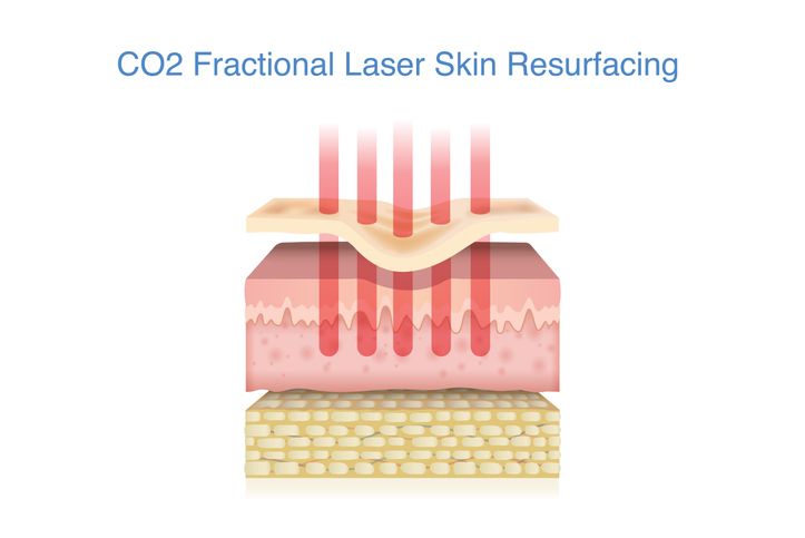 CO2 Laser 風險解析：4大美容功效+治療後注意事項！