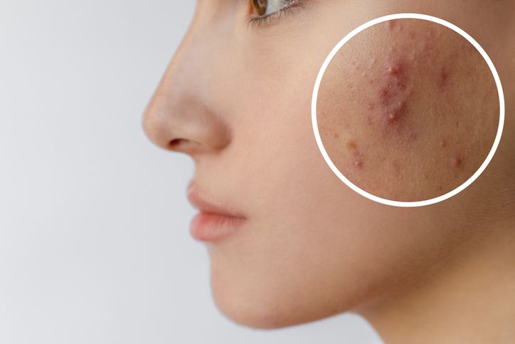 男士去角質產品推薦：使用全面攻略 — 打破粗糙肌膚的秘密！搭配「這療程」效果更佳！