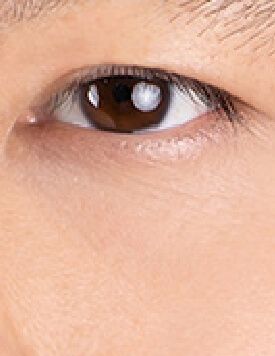 BTL Exilis Pro-療程後