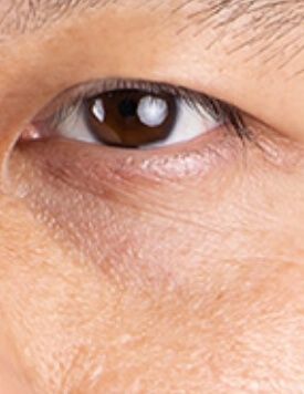 BTL Exilis Pro-療程前