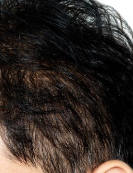 【RGA毛囊幹細胞重生】幹細胞生髮技術是什麼？一文看清優缺點！比植髮更有效更微創？