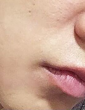 暗瘡分手-療程後