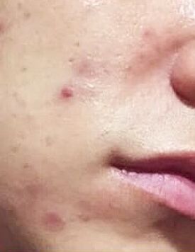 暗瘡分手-療程前