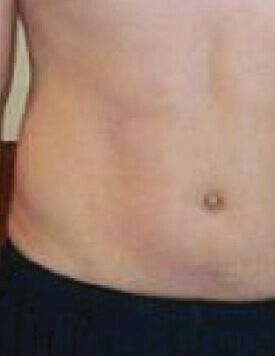 Cold Sculpt3-療程後