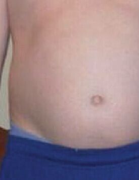 Cold Sculpt3-療程前