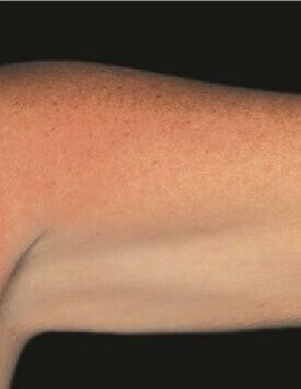 CoolShaping-療程後