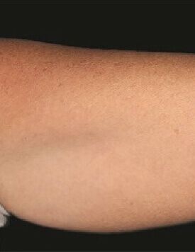 CoolShaping-療程前