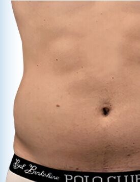 Emsculpt NEO-療程後