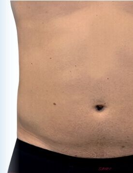 Emsculpt NEO-療程前