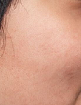 P9 去凹凸洞-療程後