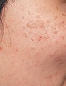 P9 去凹凸洞-療程前