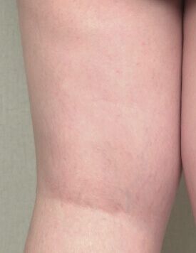 UltraShape-療程後