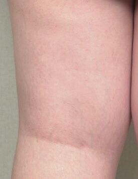 UltraShape-療程前